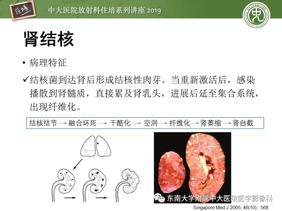 【PPT】肾脏感染性病变的影像学表现