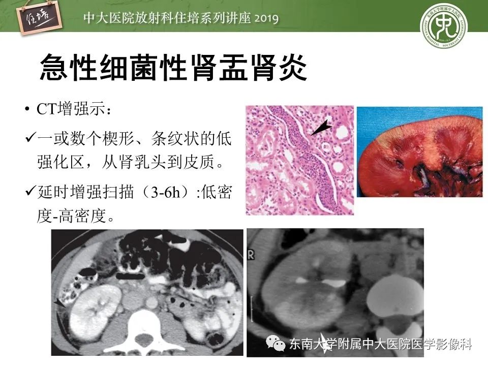 【PPT】肾脏感染性病变的影像学表现