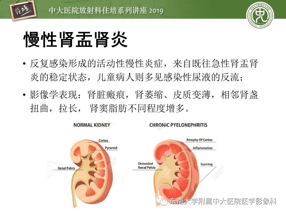 【PPT】肾脏感染性病变的影像学表现