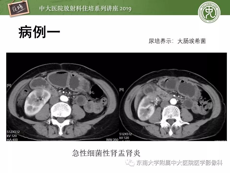 【PPT】肾脏感染性病变的影像学表现