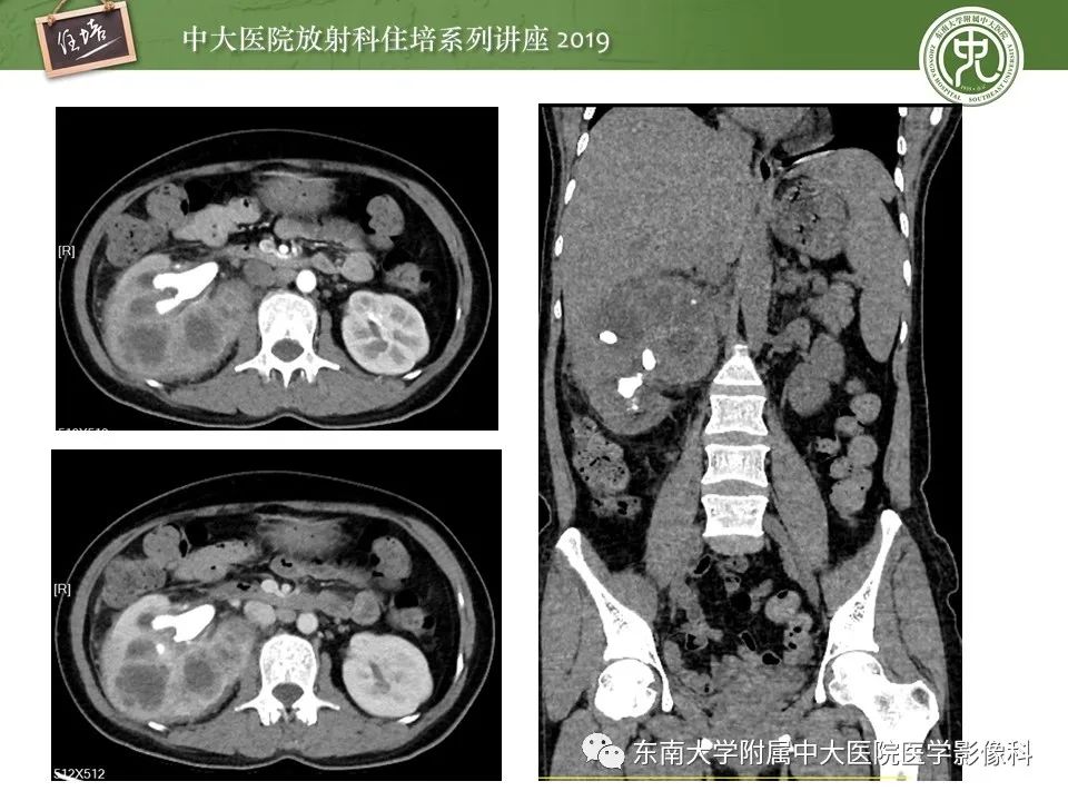 【PPT】肾脏感染性病变的影像学表现
