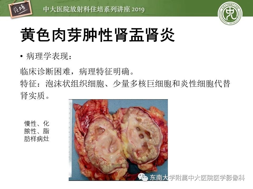 【PPT】肾脏感染性病变的影像学表现