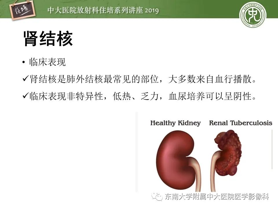 【PPT】肾脏感染性病变的影像学表现