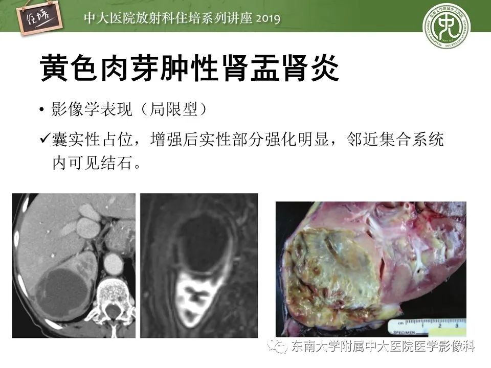 【PPT】肾脏感染性病变的影像学表现