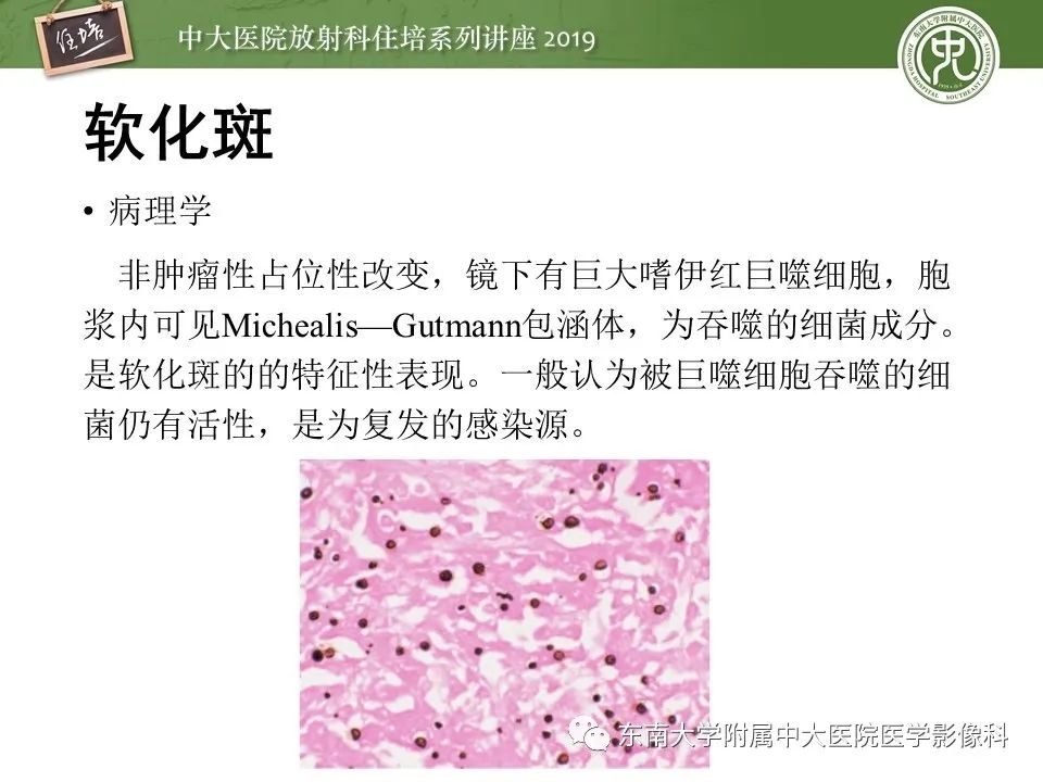 【PPT】肾脏感染性病变的影像学表现