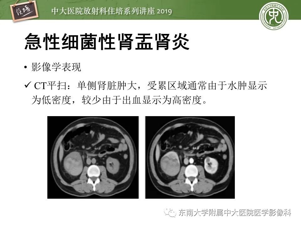 【PPT】肾脏感染性病变的影像学表现