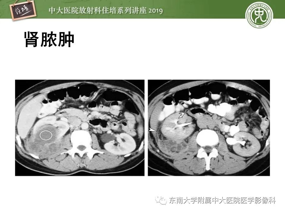 【PPT】肾脏感染性病变的影像学表现