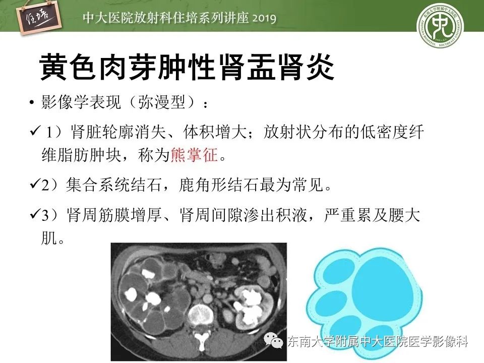 【PPT】肾脏感染性病变的影像学表现