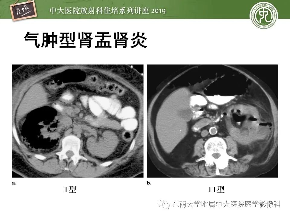 【PPT】肾脏感染性病变的影像学表现