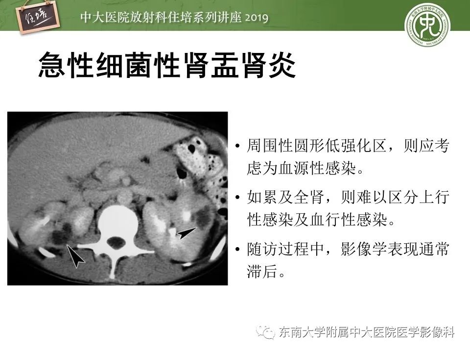 【PPT】肾脏感染性病变的影像学表现