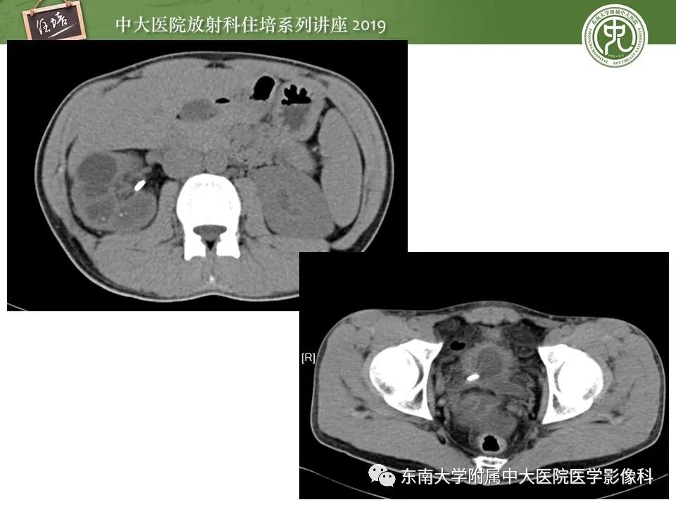 【PPT】肾脏感染性病变的影像学表现