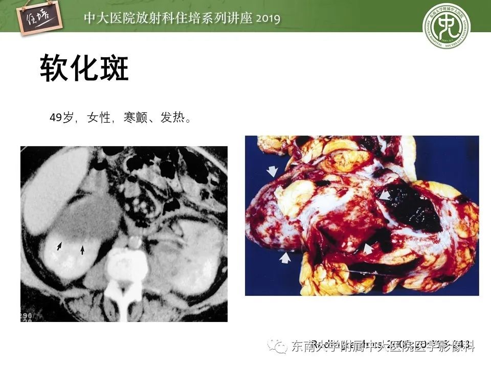 【PPT】肾脏感染性病变的影像学表现
