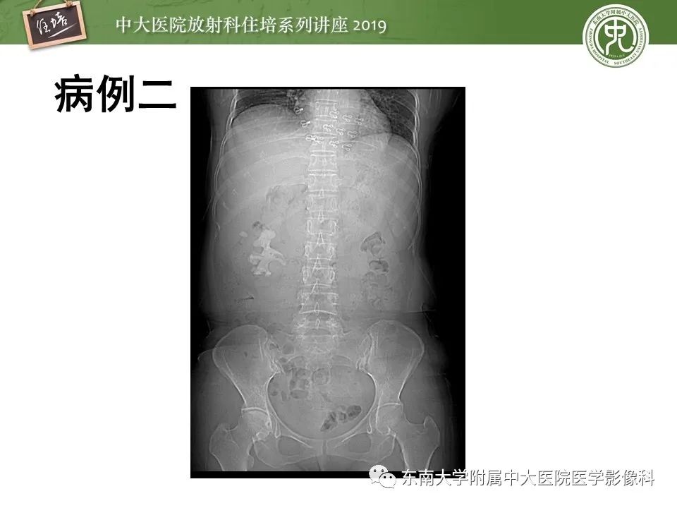 【PPT】肾脏感染性病变的影像学表现
