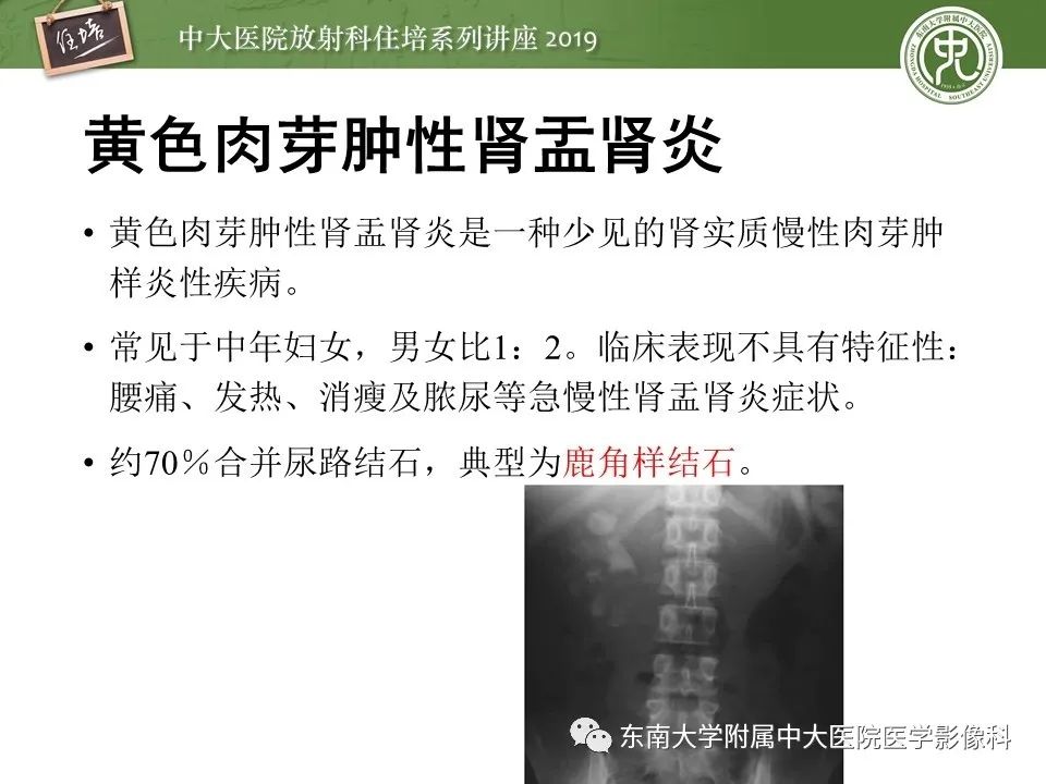 【PPT】肾脏感染性病变的影像学表现