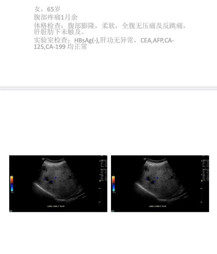 【病例】肝脏原发性血管肉瘤1例CT影像讨论