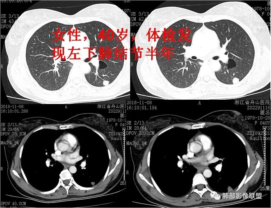 【病例】肺结节2例影像讨论