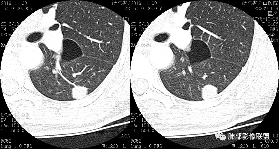 【病例】肺结节2例影像讨论