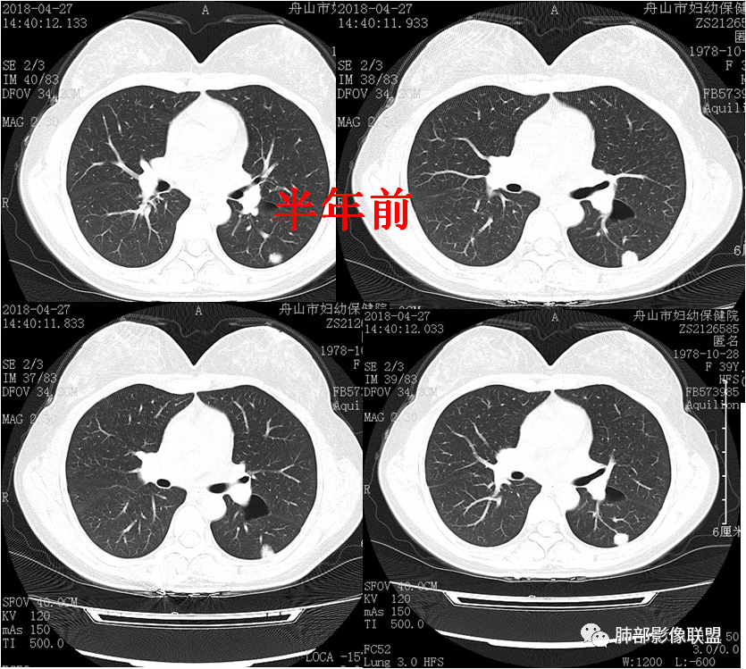 【病例】肺结节2例影像讨论