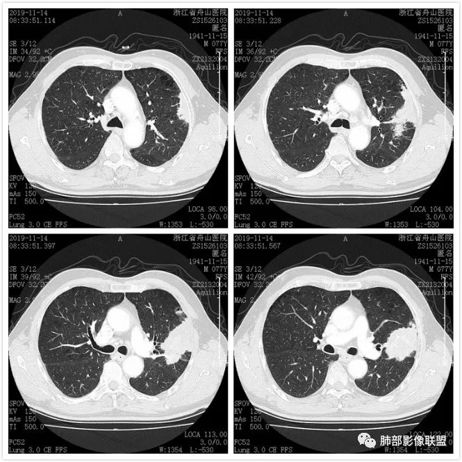 【病例】真假支气管爬行征—肺腺癌1例CT影像讨论