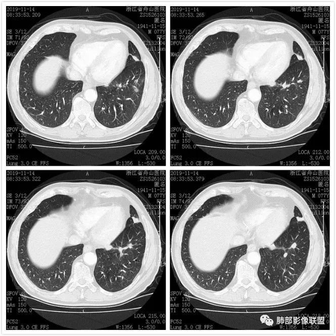 【病例】真假支气管爬行征—肺腺癌1例CT影像讨论