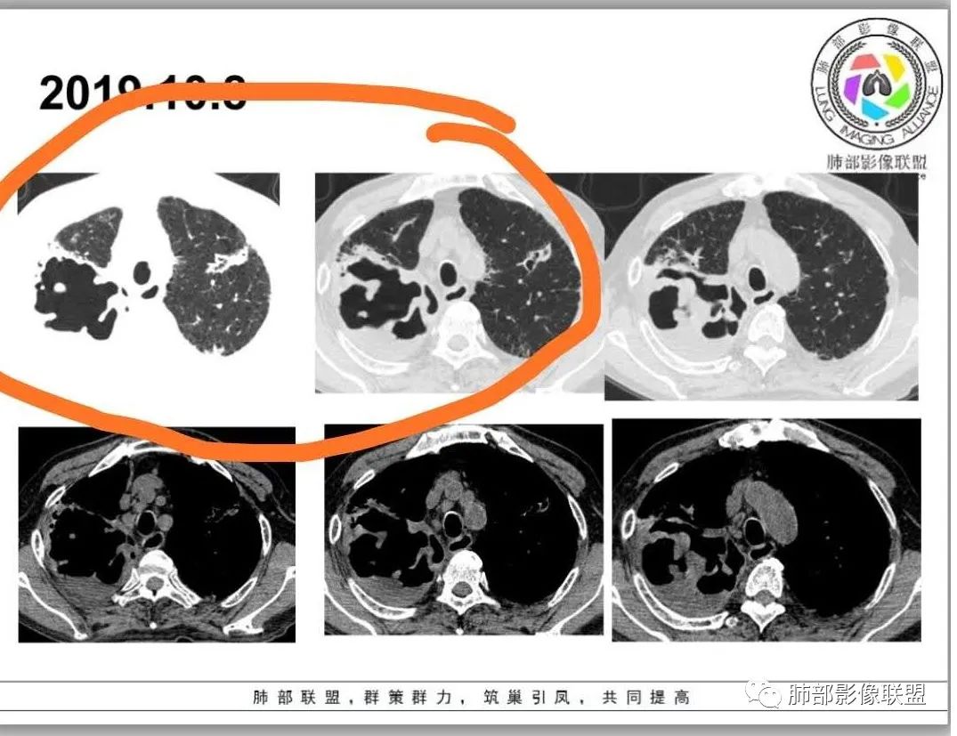 【病例】结核千面妖