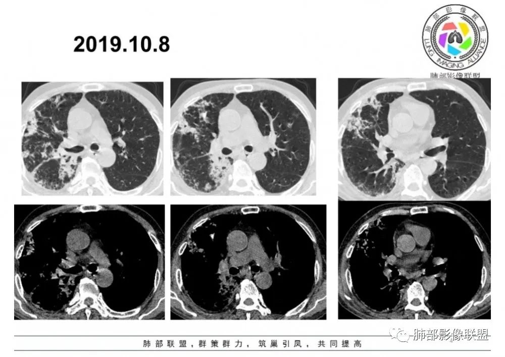 【病例】结核千面妖 【病例】结核千面妖