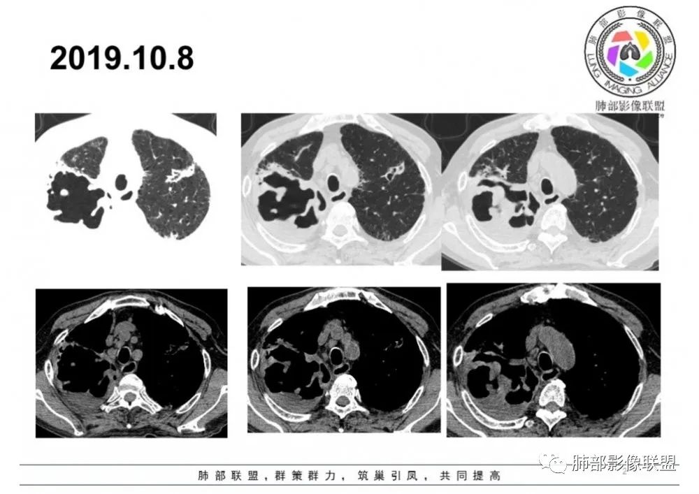 【病例】结核千面妖