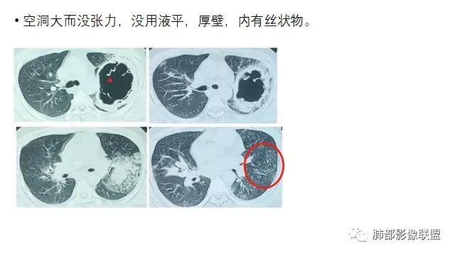 【病例】结核千面妖