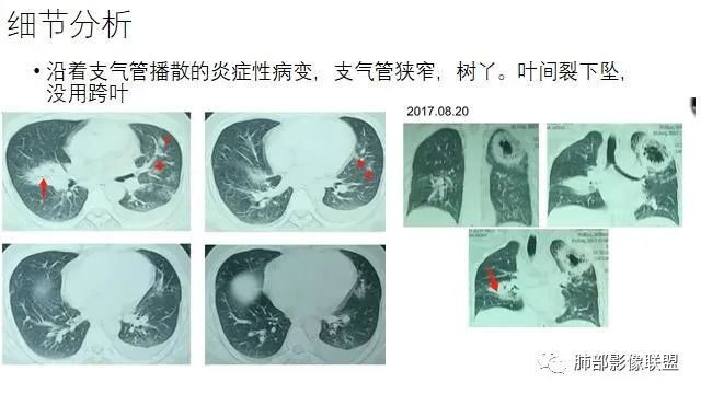 【病例】结核千面妖