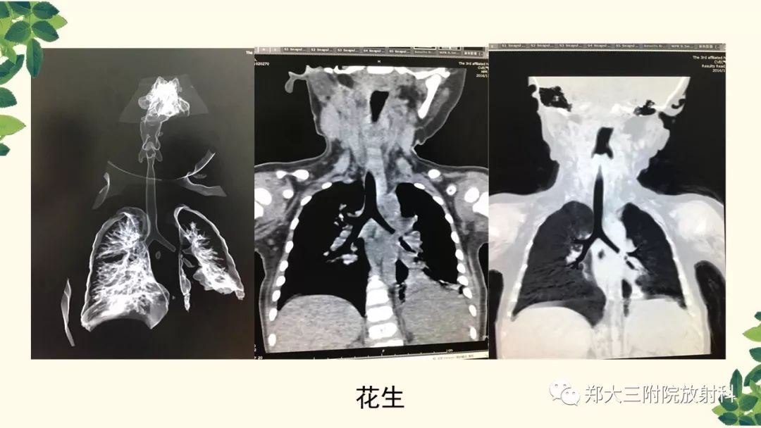【PPT】支气管异物的CT分析