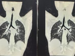 支气管异物的CT分析