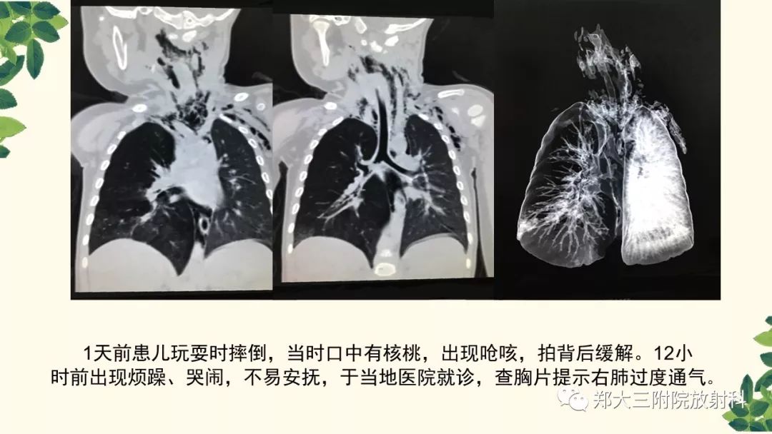 【PPT】支气管异物的CT分析