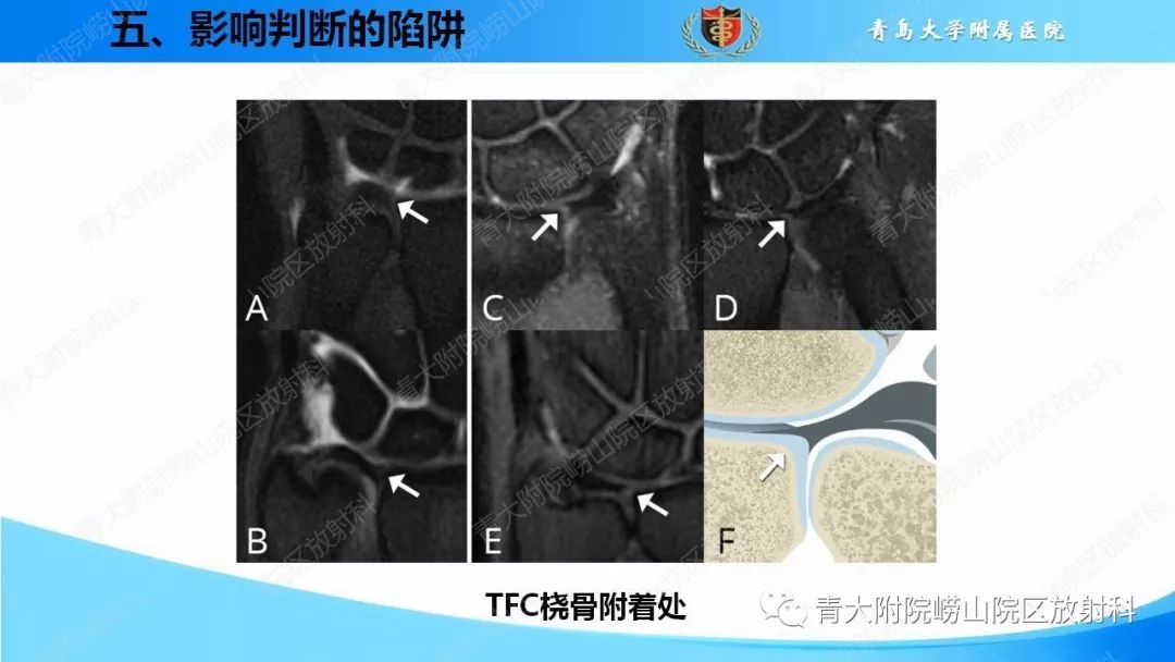 【PPT】TFCC损伤的MRI诊断