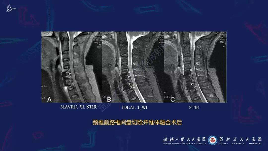 【PPT】肌骨MRI金属伪影抑制技术临床应用