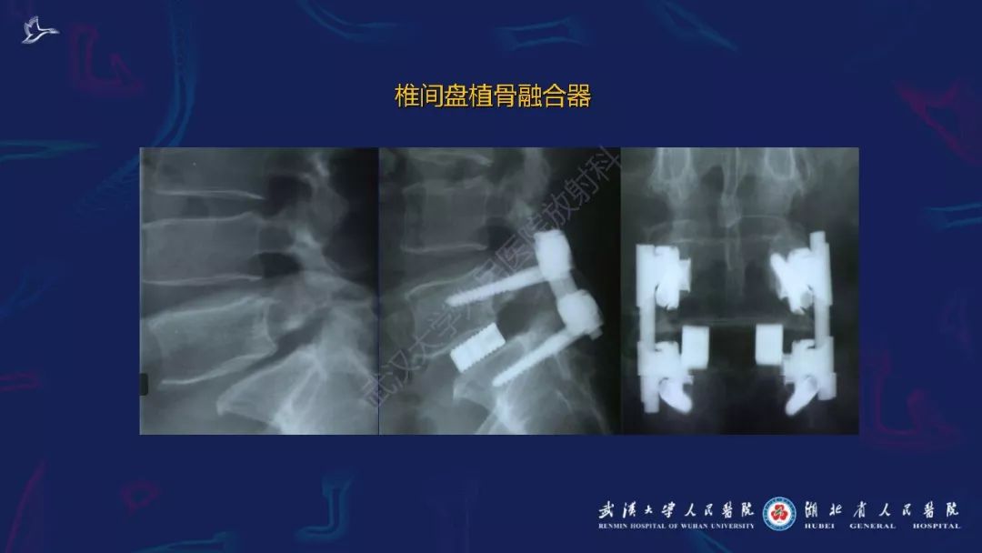 【PPT】肌骨MRI金属伪影抑制技术临床应用