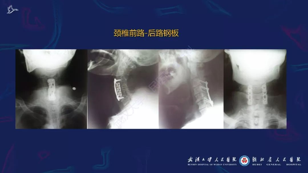 【PPT】肌骨MRI金属伪影抑制技术临床应用