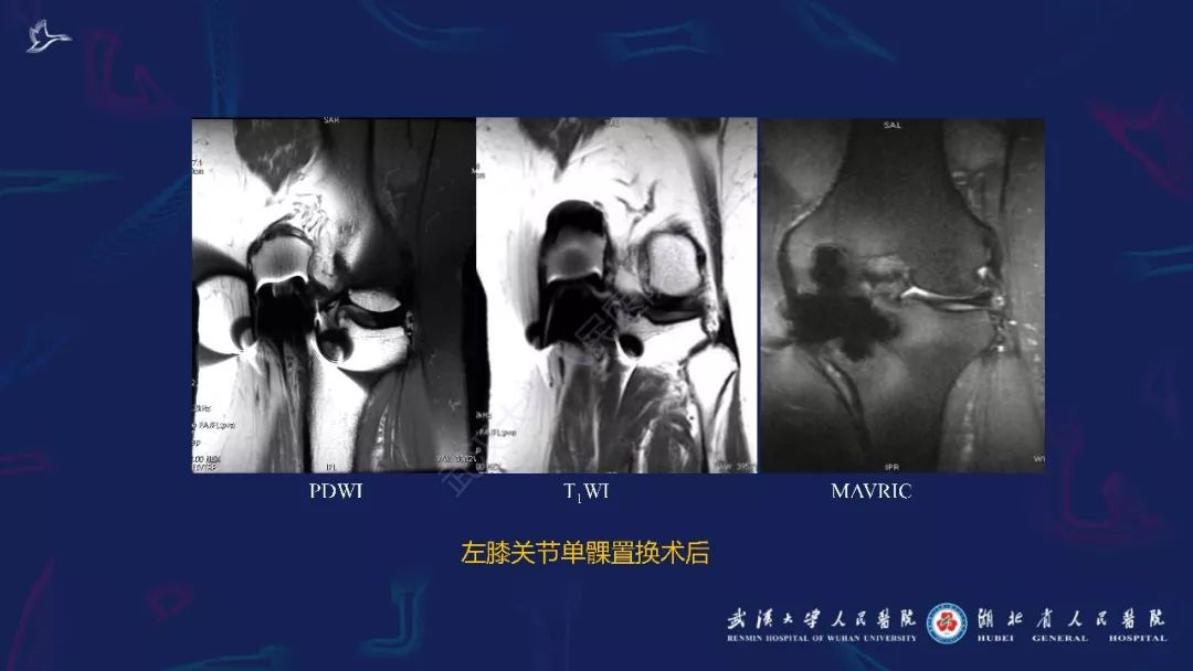 【PPT】肌骨MRI金属伪影抑制技术临床应用