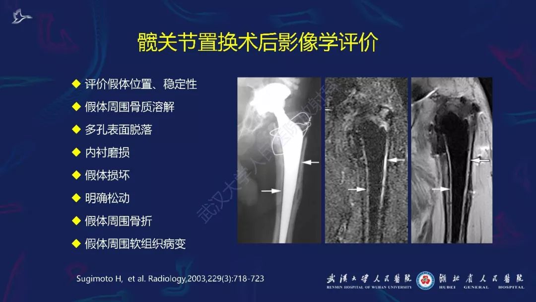 【PPT】肌骨MRI金属伪影抑制技术临床应用
