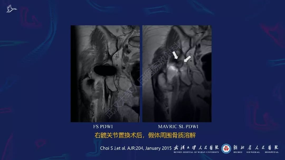 【PPT】肌骨MRI金属伪影抑制技术临床应用