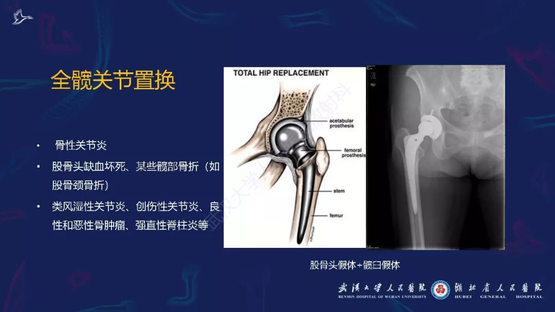 【PPT】肌骨MRI金属伪影抑制技术临床应用