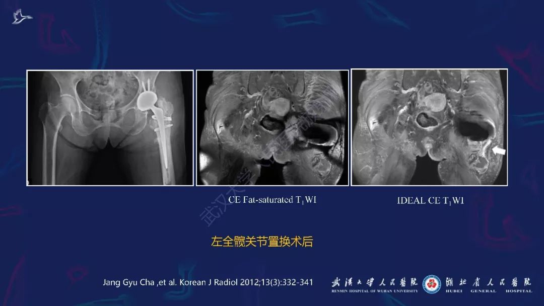 【PPT】肌骨MRI金属伪影抑制技术临床应用