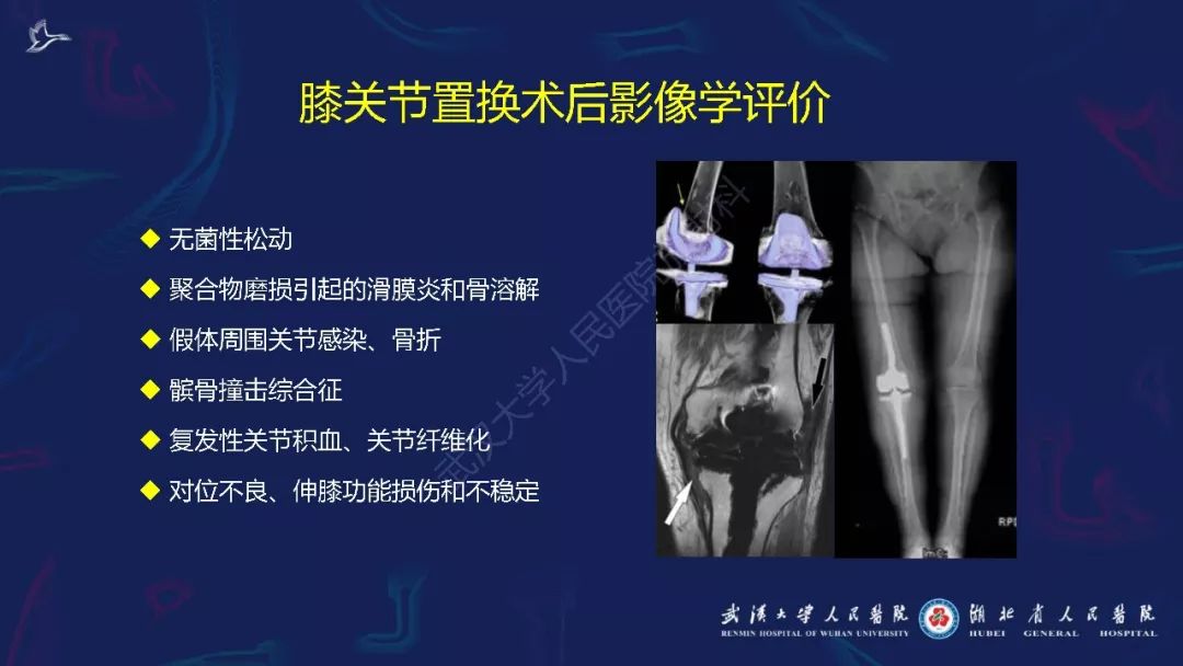 【PPT】肌骨MRI金属伪影抑制技术临床应用