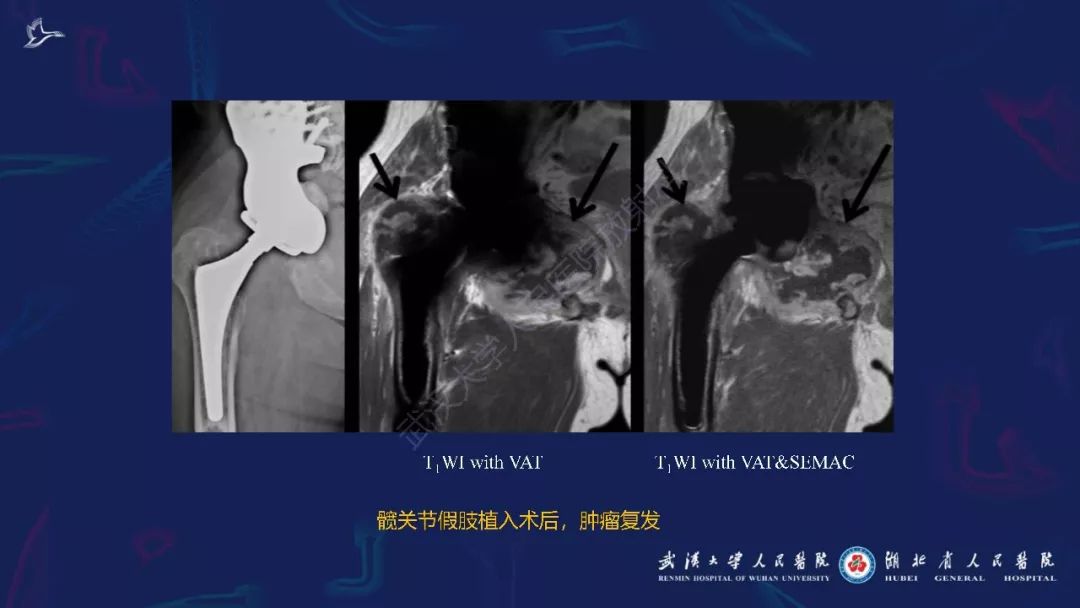【PPT】肌骨MRI金属伪影抑制技术临床应用