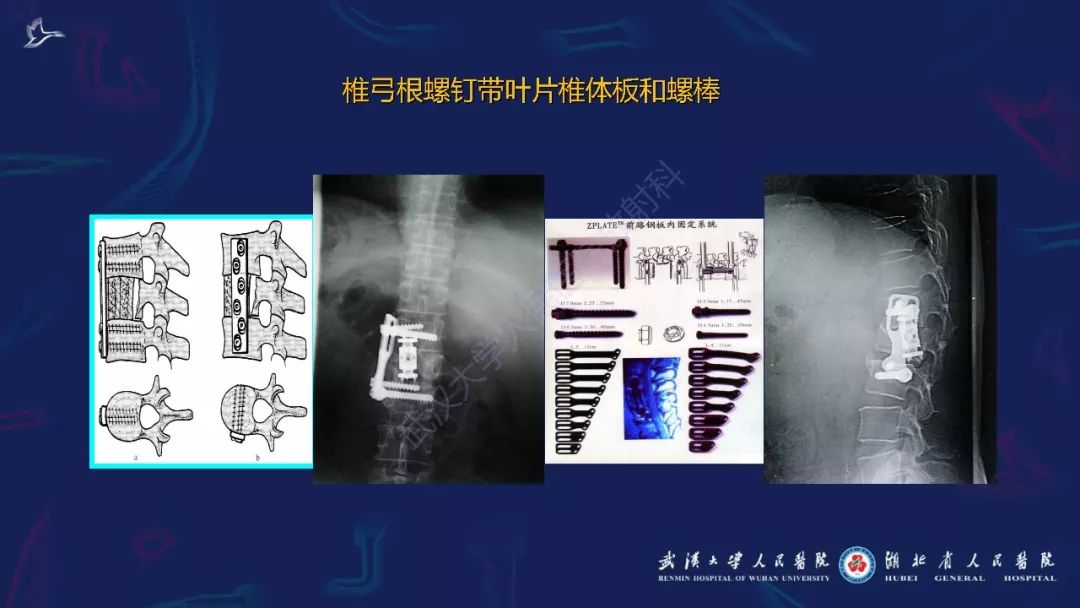 【PPT】肌骨MRI金属伪影抑制技术临床应用