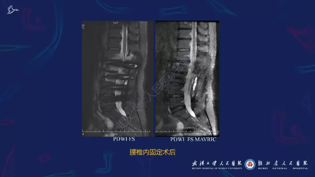 【PPT】肌骨MRI金属伪影抑制技术临床应用