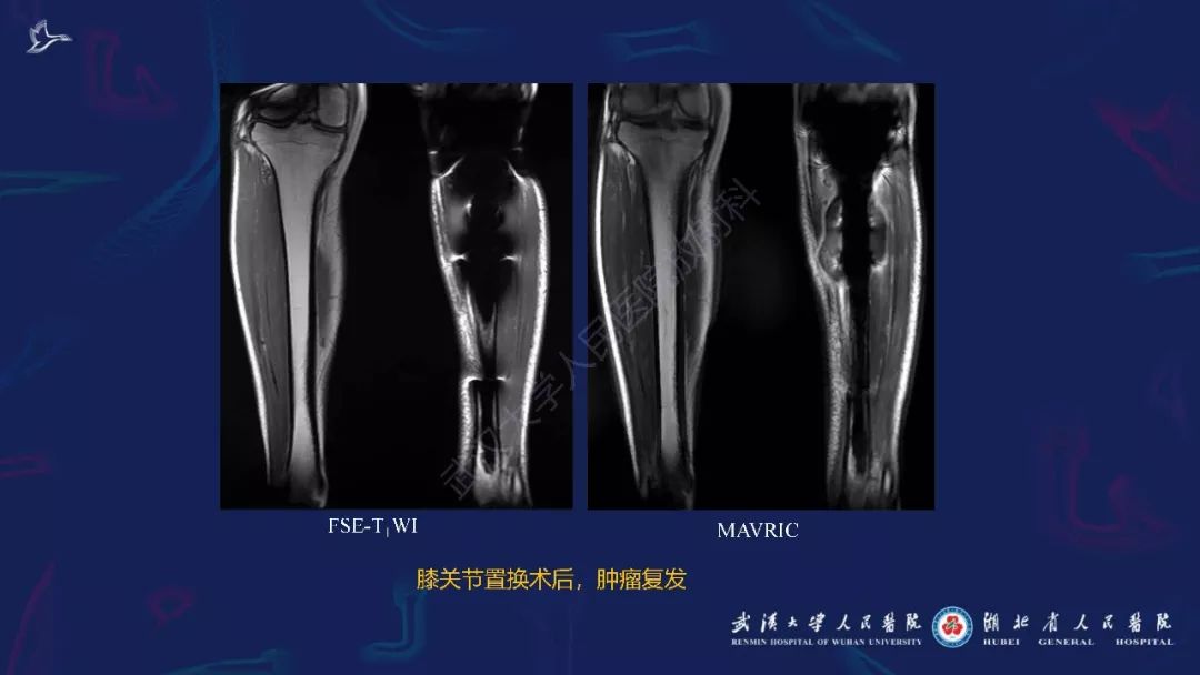 【PPT】肌骨MRI金属伪影抑制技术临床应用