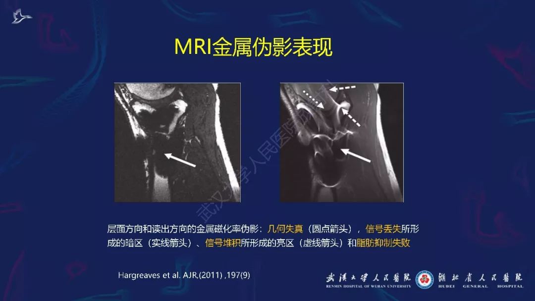 【PPT】肌骨MRI金属伪影抑制技术临床应用