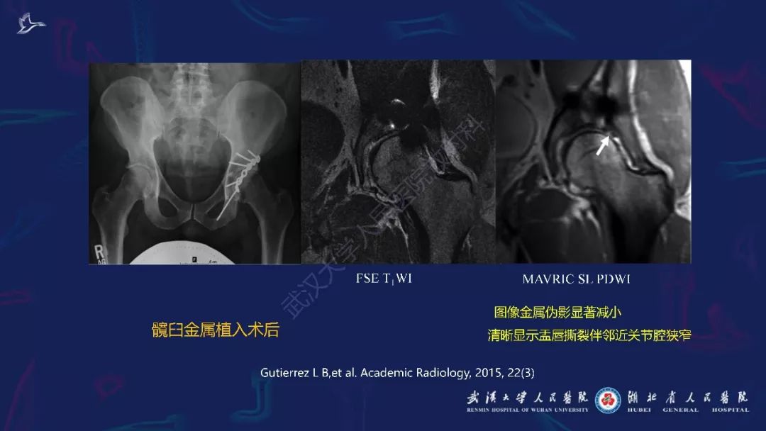 【PPT】肌骨MRI金属伪影抑制技术临床应用
