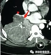 【病例】右中下肺典型类癌1例CT影像讨论
