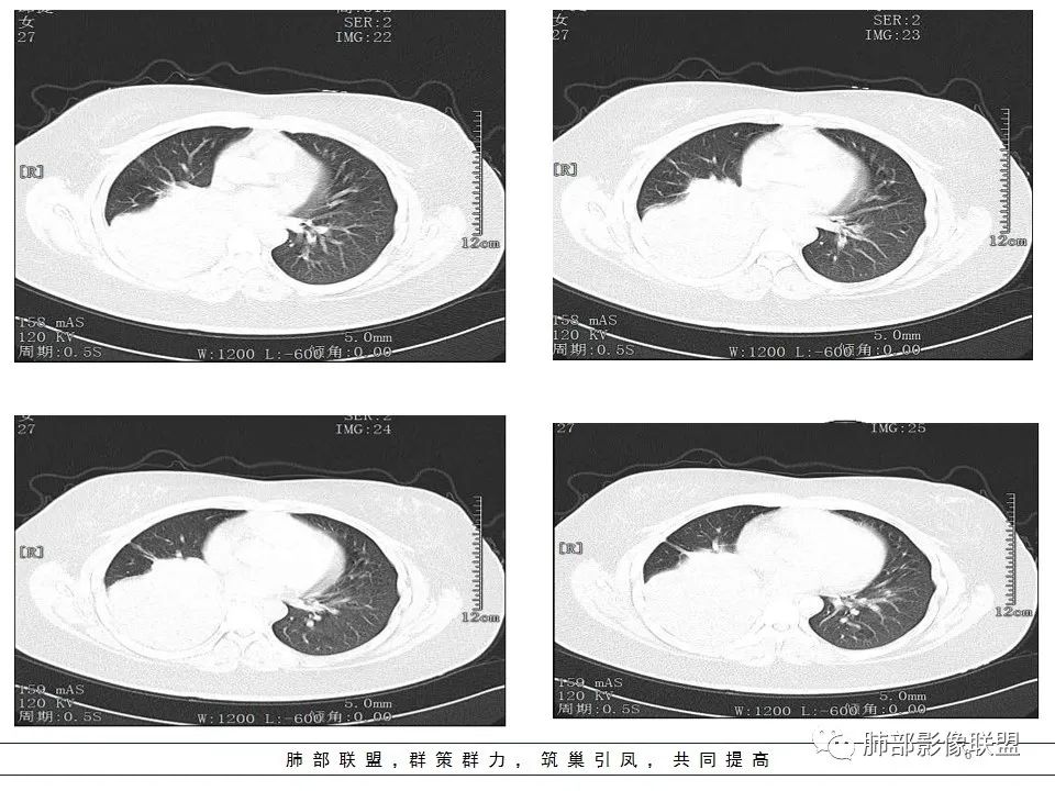 【病例】右中下肺典型类癌1例CT影像讨论